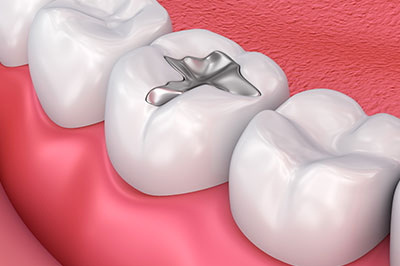 Falls Dental Care Group | Veneers, Night Guards and Pediatric Dentistry