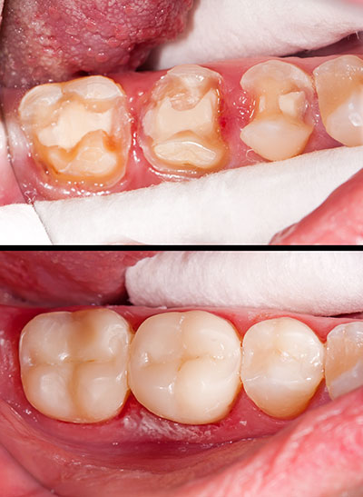 Falls Dental Care Group | Pediatric Dentistry, Teeth Whitening and Sports Mouthguards