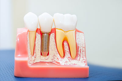 Falls Dental Care Group | Digital Radiography, Dental Fillings and Periodontal Treatment