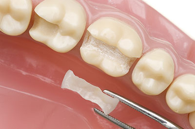 Falls Dental Care Group | Crowns   Caps, All-on-4 reg  Implants and Pediatric Dentistry