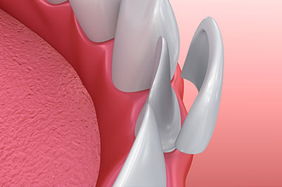 Falls Dental Care Group | Teeth Whitening, Bridges and Emergency Treatment