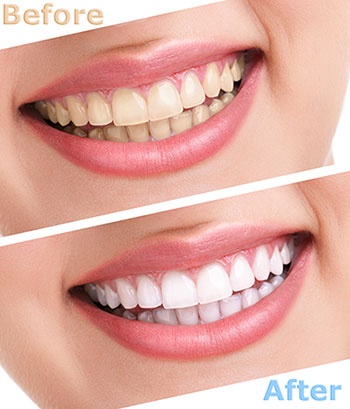 Falls Dental Care Group | Emergency Treatment, Sports Mouthguards and Veneers